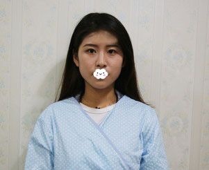 天生一单一双找荆州华美医疗美容李杰做埋线双眼皮后像妈妈生的一样自然