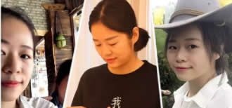 柳州做双眼皮哪里好?上传我在华美整形做7MM全切双眼皮+鼻综合隆鼻后28天恢复过程图