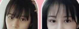 柳州做双眼皮哪里好?上传我在华美整形做7MM全切双眼皮+鼻综合隆鼻后28天恢复过程图 图2