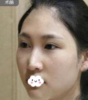 随州奥莱隆鼻整形效果怎么样?韩国进口三段式硅胶假体隆鼻术后恢复过程图