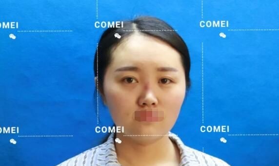 脸大的我在南通康美只做了膨体隆鼻后居然变小了,活动价总共才花了不到6千元