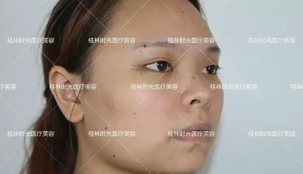 实拍:我在桂林时光整形做膨体+肋软骨鼻综合隆鼻及假体隆下巴真实恢复期图片