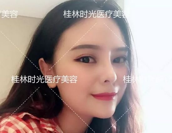 实拍:我在桂林时光整形做膨体+肋软骨鼻综合隆鼻及假体隆下巴真实恢复期图片 图2