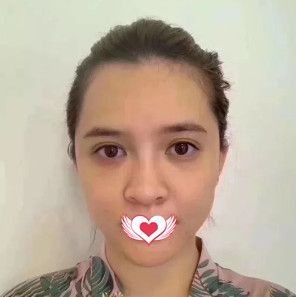 记录在邢台遇见美做鼻综合术后1个月的恢复情况 没想到我的矮塌鼻也能蜕变欧美范的高挺鼻