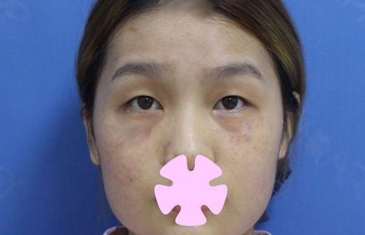 变美一步到位:晒下我在桂林华美整形做无痕双眼皮+开眼角+激光祛斑20天恢复照片
