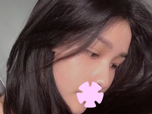 变美一步到位:晒下我在桂林华美整形做无痕双眼皮+开眼角+激光祛斑20天恢复照片 图2