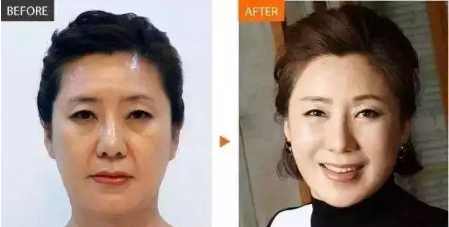 贵阳华美微雕逆龄术5大技术优势及真人案例见证线雕效果好不好。