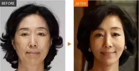 贵阳华美微雕逆龄术5大技术优势及真人案例见证线雕效果好不好。 图2