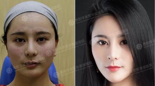 贵阳华美整形玻尿酸丰苹果肌太阳穴垫下巴等案例效果集锦