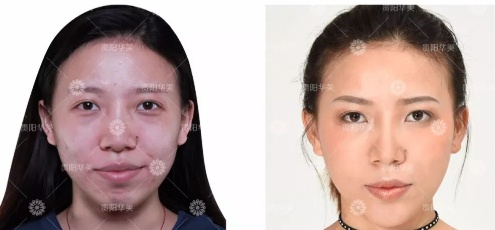 贵阳华美整形玻尿酸丰苹果肌太阳穴垫下巴等案例效果集锦 图2