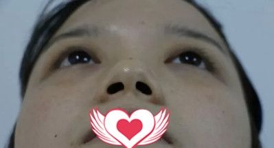 自体软骨隆鼻术后2个月呈现宛若天生的翘鼻效果 看来我选择邯郸京美是挺靠谱的