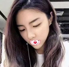 保定蓝山郑永生做自体耳软骨隆鼻术后1个月为我打造可以揉捏的人工美鼻 案例图2