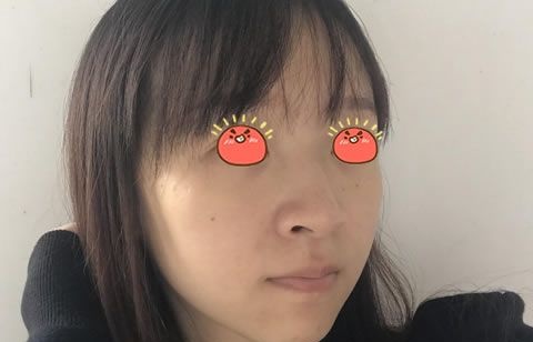 自打在嘉兴曙光医院做完鼻中隔和驼峰鼻综合矫正后,朋友说我的鼻子和脸终于协调了