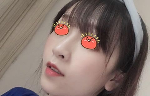 自打在嘉兴曙光医院做完鼻中隔和驼峰鼻综合矫正后,朋友说我的鼻子和脸终于协调了 图2
