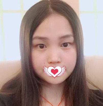 一起来看单眼皮+上睑下垂的我在邯郸丽人做完眼综合术后的效果怎么样