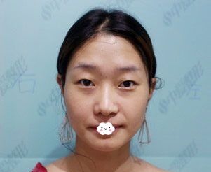 做梦也没想到找湖北正规整形医院黄石中爱万文勇做双眼皮开眼角后颜值暴涨