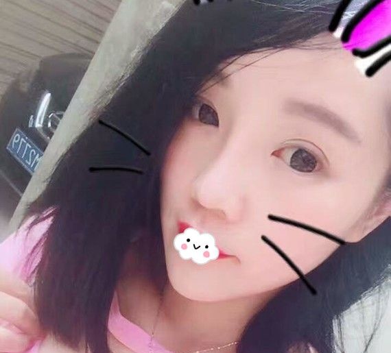 这是万文勇做的鼻中隔软骨隆鼻恢复图,大家说黄石中爱隆鼻效果怎么样? 案例图2