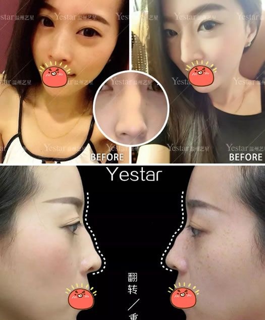 温州艺星做驼峰鼻矫正手术用时80多分钟,花了我2万多,从术后30天效果来看我觉得物有所值
