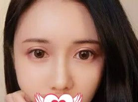 秦皇岛纪辉的自体脂肪面部填充术让我告别衰老下垂的大妈脸 图2