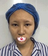 这次在邢台遇见美做的眼鼻综合手术 给我的感受就是整形前后对比效果反差挺大