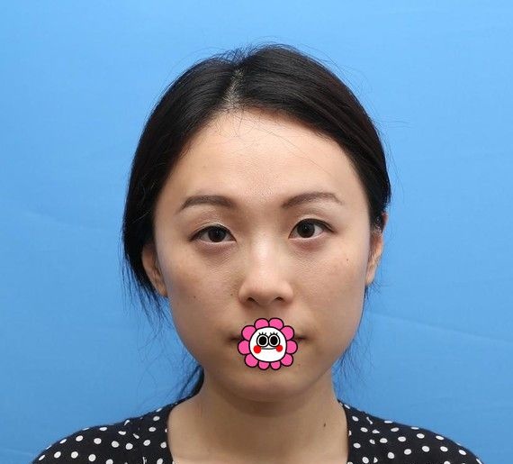 西宁割双眼皮哪里好?看我一大一小的眼睛在西宁时光找薛政做切开双眼皮恢复经历就知道啦