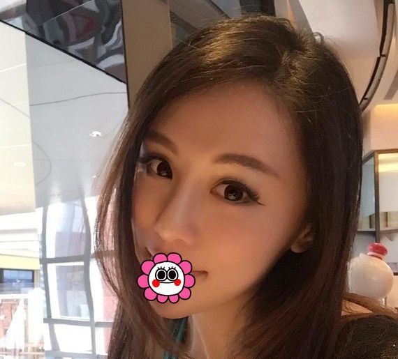 西宁割双眼皮哪里好?看我一大一小的眼睛在西宁时光找薛政做切开双眼皮恢复经历就知道啦 图2