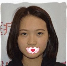 邢台遇见美韩伟强院长做达拉斯鼻综合手术为我雕刻宛若天生的优雅鼻