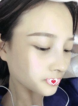 邢台遇见美韩伟强院长做达拉斯鼻综合手术为我雕刻宛若天生的优雅鼻 图2