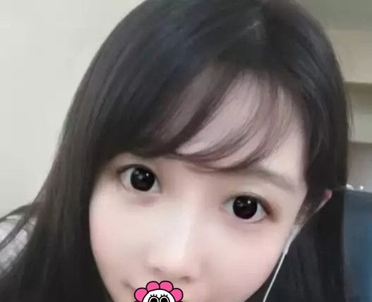 自体脂肪填充存活率高吗?通过我初次在西宁时光做自体脂肪填充面部的经历来说明 图2