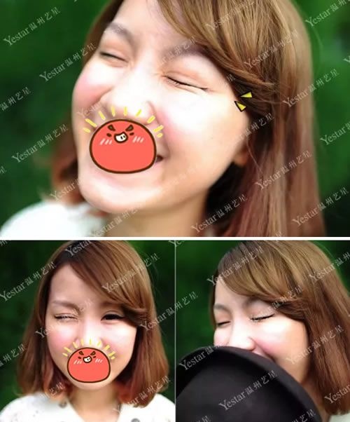鱼尾纹如何消除,我选择温州Yestar艺星除皱针来去鱼尾纹,手术10分钟,8天后就挤不出皱纹了 图2