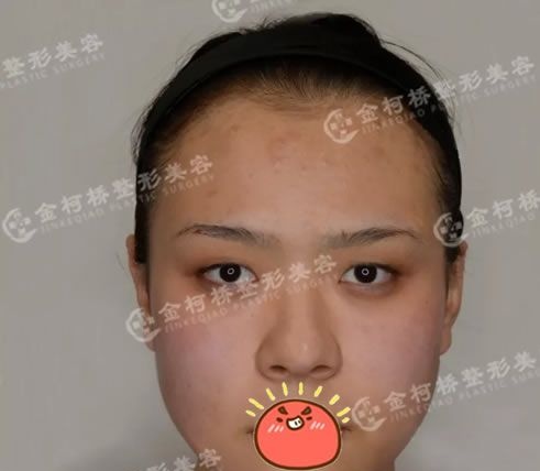 一个月前在绍兴金柯桥医院做了全切双眼皮,把割双眼皮后预防疤痕增生的方法写给大家