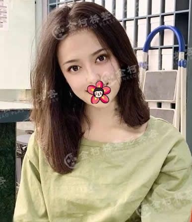 一个月前在绍兴金柯桥医院做了全切双眼皮,把割双眼皮后预防疤痕增生的方法写给大家 图2