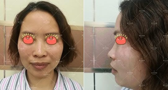 想知道隆鼻术后多久消肿的姐妹们,可以参考我在金华瑞丽刘政这做完假体隆鼻的恢复过程