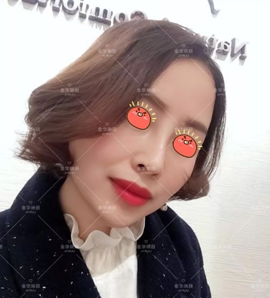 想知道隆鼻术后多久消肿的姐妹们,可以参考我在金华瑞丽刘政这做完假体隆鼻的恢复过程 图2