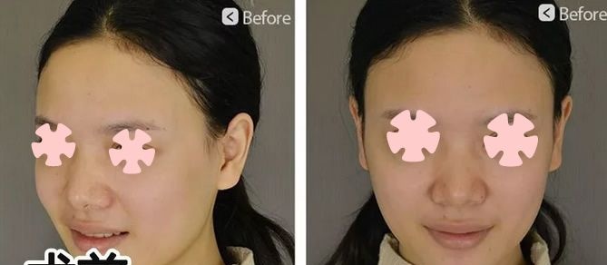 直播我在柳州华美整形做鼻综合隆鼻+全面部自体脂肪填充术后100天恢复过程