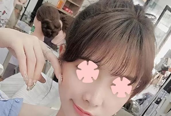 直播我在柳州华美整形做鼻综合隆鼻+全面部自体脂肪填充术后100天恢复过程 图2
