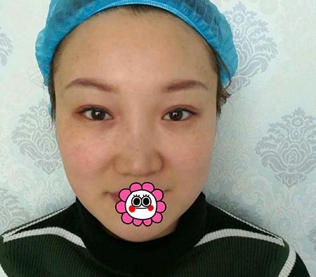 真的没想到来佳木斯韩艺找李明贤做了耳软骨隆鼻后，朋友觉着不错也准备去