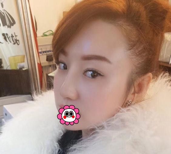 真的没想到来佳木斯韩艺找李明贤做了耳软骨隆鼻后,朋友觉着不错也准备去 图2