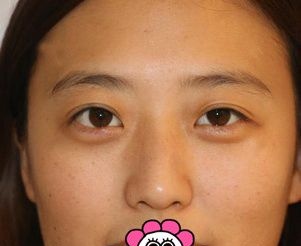 心动不如行动，来佳木斯韩艺来找李明贤做切开双眼皮的效果令我很满意