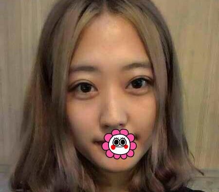 心动不如行动,来佳木斯韩艺来找李明贤做切开双眼皮的效果令我很满意 图2