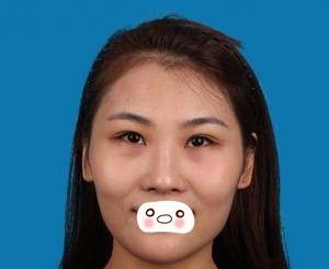 我的鼻综合手术日记-看洛阳爱尚李进雯帮我打造的高翘立挺小美鼻
