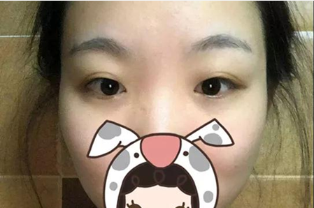 大家看看我在广元美华整形美容医院找杨林做这双眼皮效果,花8000值不值