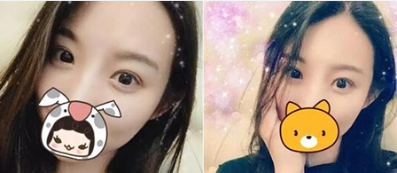 大家看看我在广元美华整形美容医院找杨林做这双眼皮效果,花8000值不值 图2