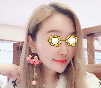 三个月前在锦州斯美诺做了全脸线雕提升效果挺好的,跟大家分享一下恢复效果图! 图2
