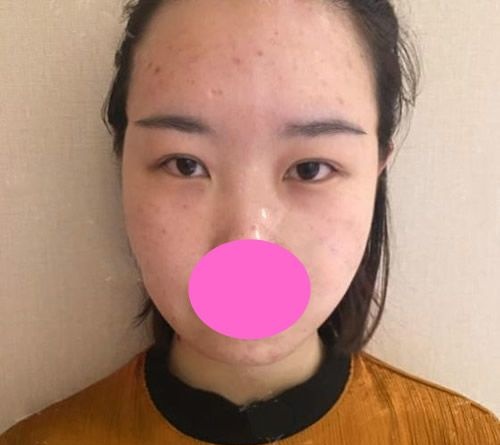 肿眼泡的我到西宁整形医院排名前三韩美做了全切双眼皮,术后1个月过程图分享