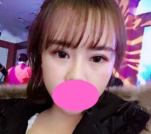 肿眼泡的我到西宁整形医院排名前三韩美做了全切双眼皮,术后1个月过程图分享 图2