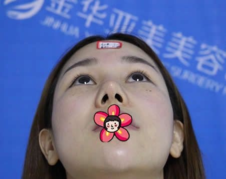 前一次假体隆鼻后被我不小心把鼻子撞歪了,这次选择金华亚美邓泽臣做鼻修复还顺便做了双眼皮和开外眼角