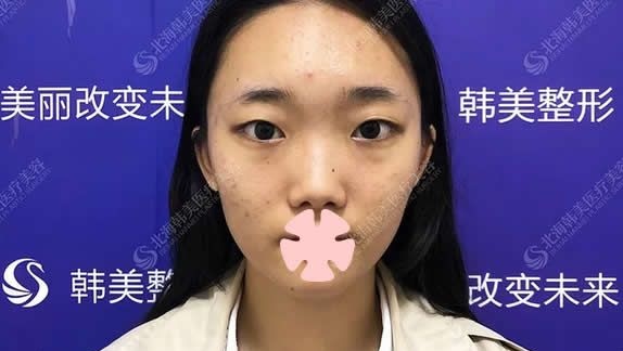 一次性在北海韩美整形做了肋软骨鼻综合隆鼻/全切双眼皮/开内眼角,上传40天恢复图