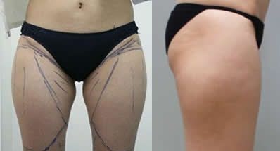 抽脂成功案例:本人在北海韩美整形做大腿水动力环形吸脂2个月后拥有纤细美腿