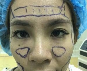 分享我在洛阳毛大夫医疗的面部脂肪填充日记 短短一个月后 面若桃花楚楚动人